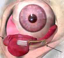 Oční implantát k léčbě xeroftalmie