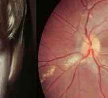 Oční larvální toxokaróza, příznaky a léčba u dospělých