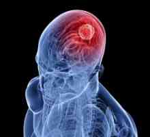 Mozek gliom: léčba, prognóza, příznaky, příznaky