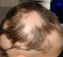 Alopecia areata: Léčba, příčiny, příznaky