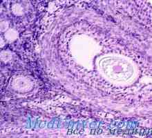 Gormonalnoaktivnye ovariální nádory. Follikuloma