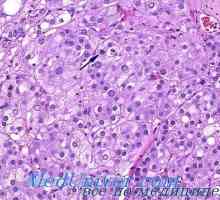 Gormonalnoaktivnye nádor kůry nadledvin