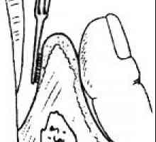 Chirurgická léčba parodontálních kapes