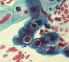 Chlamydiové infekce: léčba, příznaky, známky, diagnostika, příčiny