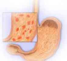Chronická erozivní gastritidu, její příznaky a stravy pomoc při léčbě