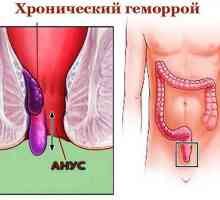 Chronické (konstantní), vnitřní a vnější hemoroidy