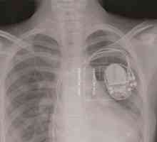 Umělý pacemaker pro plod