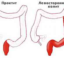 Ulcerózní kolitida je forma distální