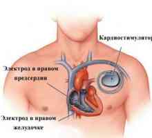 Bije na srdeční komory, léčba, příčiny, symptomy