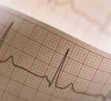 Electric infarkt nestabilita: Prostředky pro léčbu, příčiny, příznaky, znaky