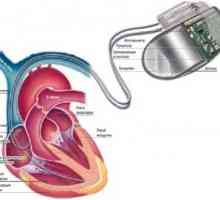 Implantovatelný kardiostimulátor