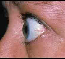 Endokrinní oftalmopatie: léčba, příznaky, diagnostika, klasifikace
