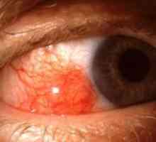 Episkleritida oko: léčba, příznaky, příčiny