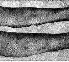 Erythema nodosum. klinický obraz