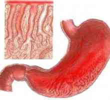 Erytematózní gastroduodenit