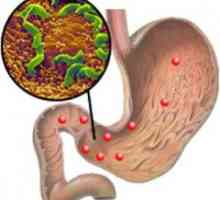 Erozivní gastritidu a Helicobacter pylori