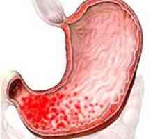 Erozivní chronickou katarální fokální povrchní gastritida