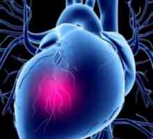 Kardiogenní šok: léčba, příznaky, příčiny, příznaky