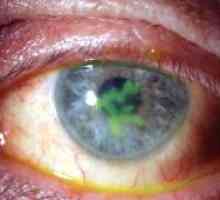 Rohovky oka: léčba, příznaky, příčiny, příznaky