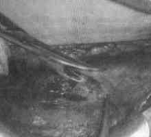 Císařský řez příčný řez v dolním segmentu děložní