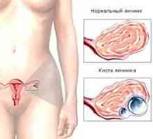 Ovariální cysta, příznaky, léčba, příčiny, příznaky