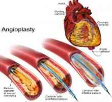 Koronární angioplastika