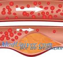 Kožní cévy v diabetes mellitus. Mikroangiopatie u diabetu