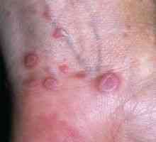 Lichen planus: příčiny, příznaky, léčba, symptomy