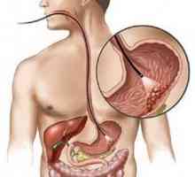 Lymfom žaludku a tlustého střeva: léčebných Pronoza, známky, symptomy, příčiny