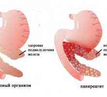 Pankreatitida indukovaná léky