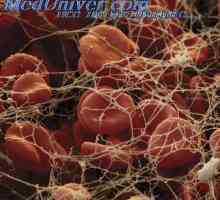 Vliv polycythemia na krevní oběh. Bílé krvinky jsou bílé krvinky
