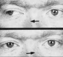 Internukleární oftalmoplegie: příznaky, léčba, příznaky, příčiny