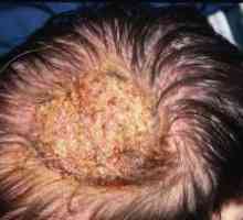 Mykóza hlava: léčba, příznaky, diagnostika, příčiny, příznaky, prevence