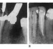 Zubní morfologii a principy endodontic