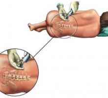 Anestezie a epidurální anestezie v průběhu chirurgického zákroku k odstranění hemoroidů