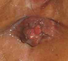 Externí hemoroidy třásně po odstranění hemoroidů