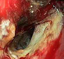 Nediferencované karcinomu žaludku a její prognóza