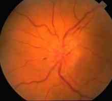 Optická neuritida: symptomy, léčba, příčiny, diagnostiku, prognostiku