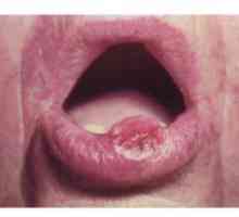 Novotvary v dutině ústní u člověka