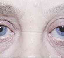 Oční, meningiom zrakového nervu