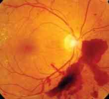 Okluze centrální retinální arterie: léčba, příčiny, diagnóza
