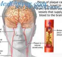 Mikrocirkulace mozku. Příčiny mrtvice