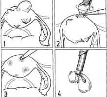 Operace na děloze. Laparoskopická myomektomie