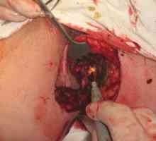 Chirurgický zákrok k odstranění hemoroidů a análních fisur