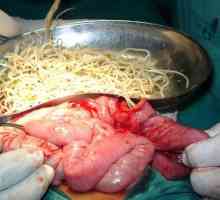 Chirurgický zákrok k odstranění červů, jak odstranit hlístů?