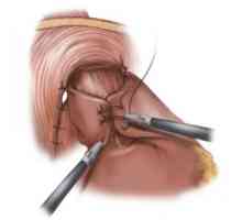 Chirurgická léčba refluxní ezofagitidy a fundoplikaci