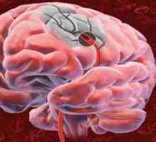 Nádor na mozku a její membrány, což vede k porážce zrakové dráhy