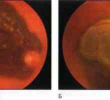 Nádory sítnice a cévnatky: choroidální melanom