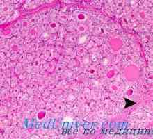 Klasifikace rakoviny štítné žlázy. Papilární (papilární) adenokarcinom