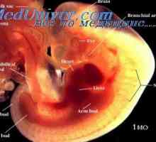 Zvláštnosti diagnostiky fetálních syndromů. Ahondrogenez a jeho frekvence